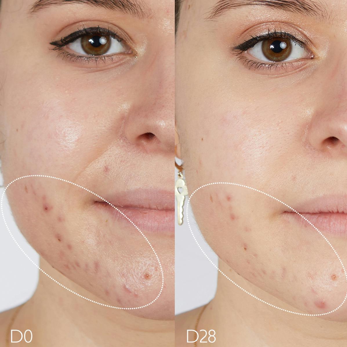 Oil-Control Moisturizer for Acne Prone Skin