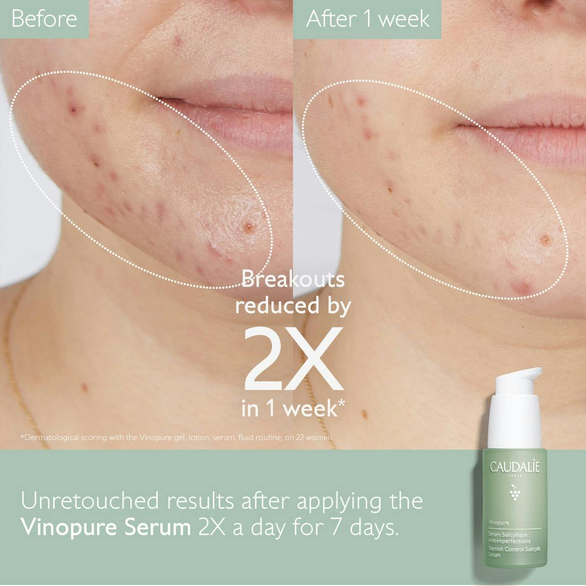 Acne-Prone Skin Essentials Set