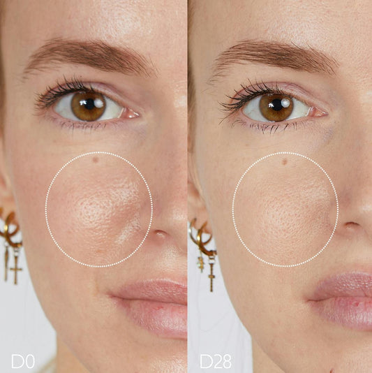 Oil-Control Moisturizer for Acne Prone Skin